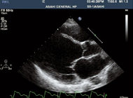 心臓超音波検査
