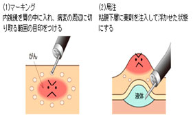 ESWL点検